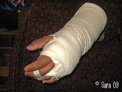 Bruten, opererad hand